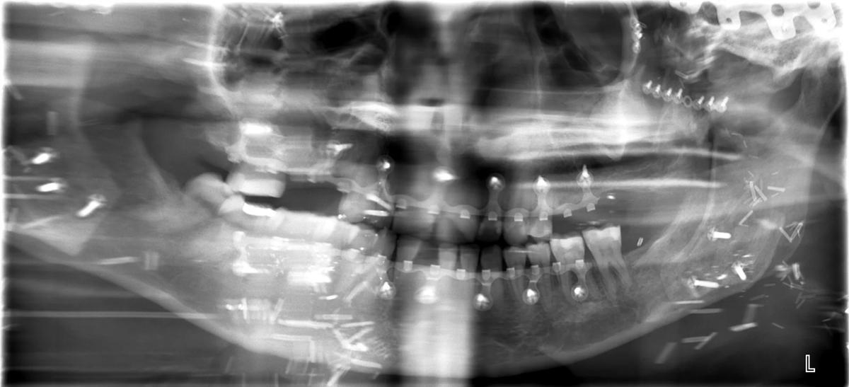 Oral Surgery performed extractions of any infected or non-restorable teeth in the time leading up to the facial transplant