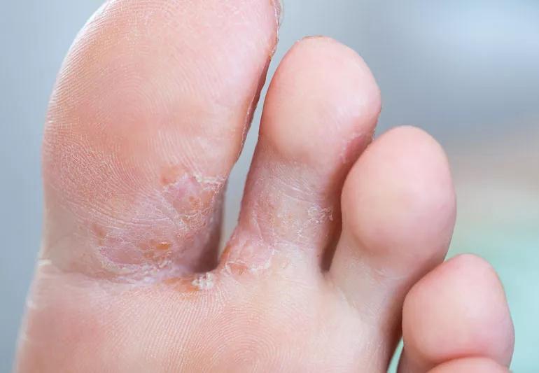 Treating Toenail Fungus