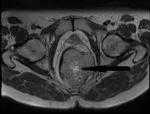 An axial MRI depicts the gastrointestinal stromal tumor originating in the lower rectum.