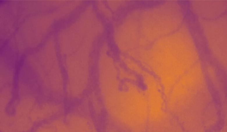 Figure 1. Sublingual capillaroscopy in a patient with PAH. The microcirculation is illuminated with a special light that creates a high-contrast image of flowing red blood cells in these superficial vessels. Red blood cells are seen as dark structures and the white blood cells as gaps. Vessel walls are delineated by the red blood cells.