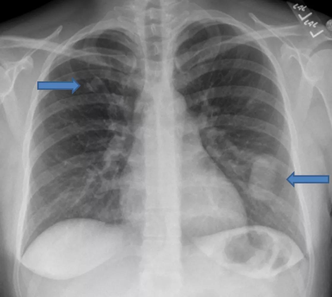 Chest Radiograph