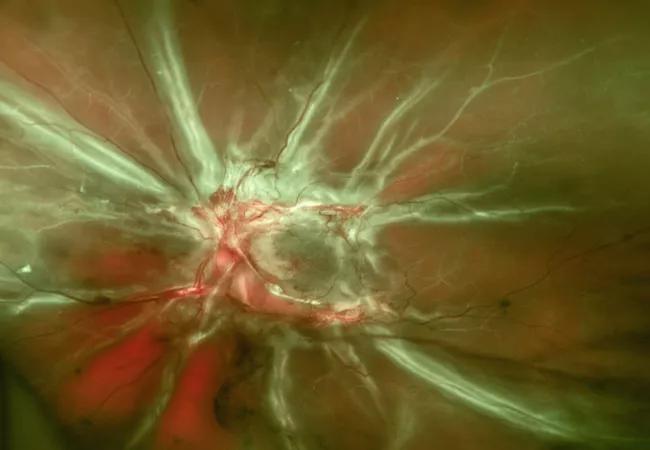 Diabetic retinopathy