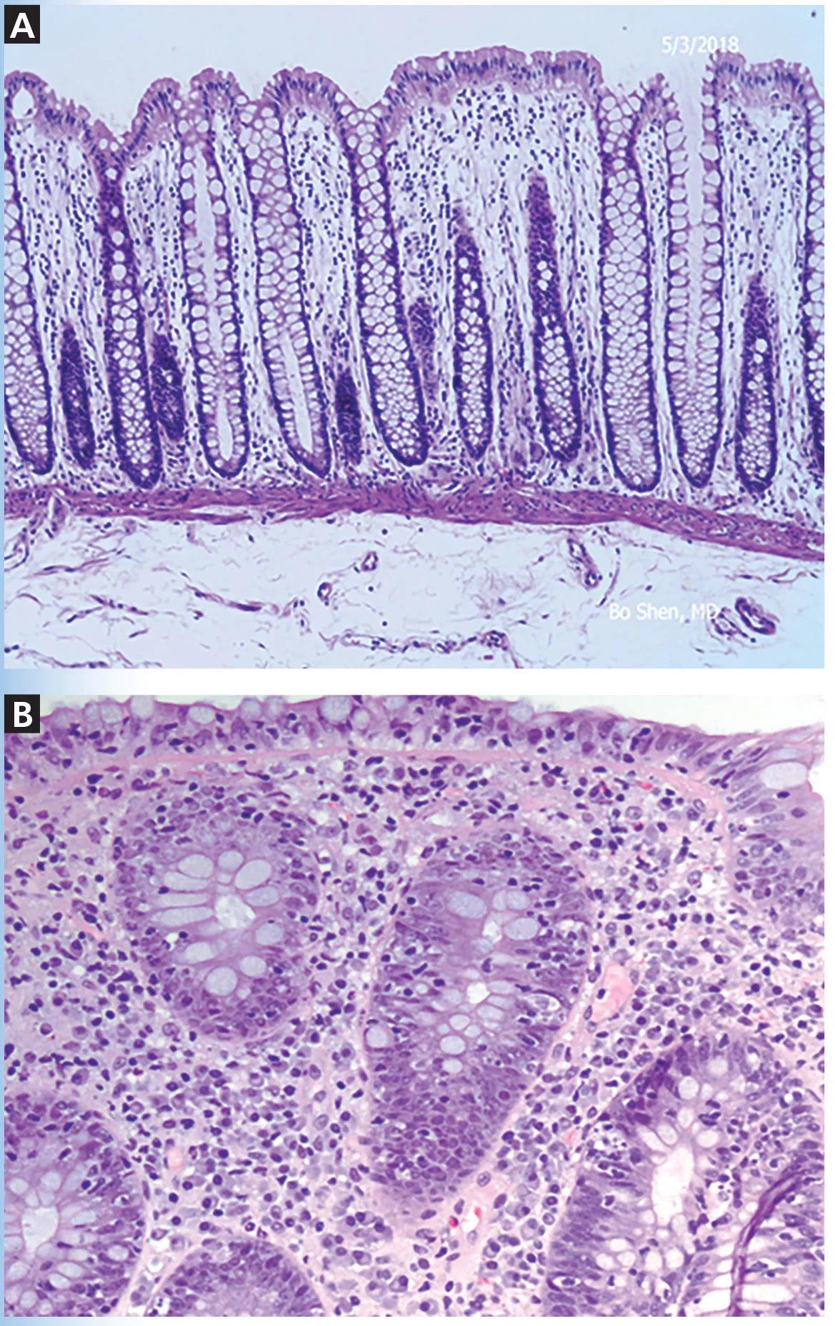 Photo of histologic features of immune checkpoint inhibitor-associated colitis.