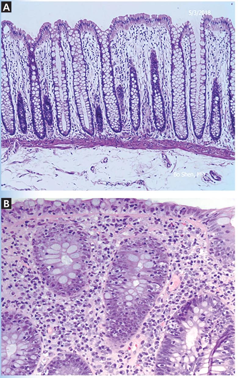 Photo of histologic features of immune checkpoint inhibitor-associated colitis.
