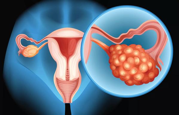 Illustration of ovarian cancer