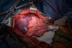 The multivisceral graft after reperfusion and hemostasis are achieved.