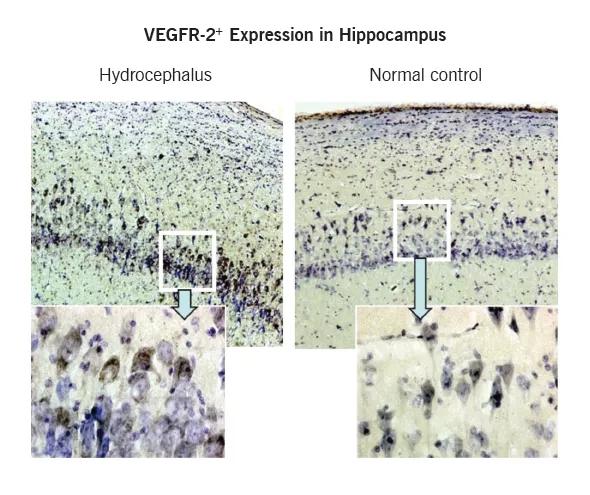 Figure 2. Photomicrographs showing increased expression of the VEGFR-2+ receptor in the hippocampal CA2/3 region in canine chronic hydrocephalus (left) relative to surgical control (right). Reprinted from Neuroscience (Dombrowski et al4), ©2008 Elsevier BV.