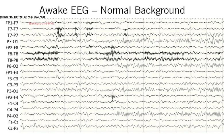 eeg recording from an awake patient