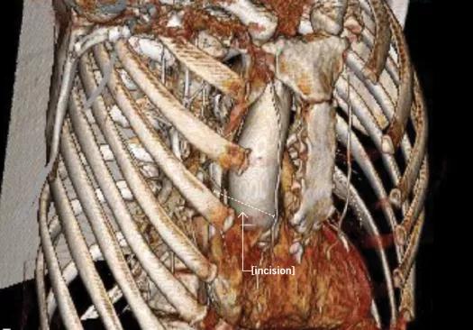 A sternal-sparing minithoracotomy incision allowed excellent access to the aortic valve.