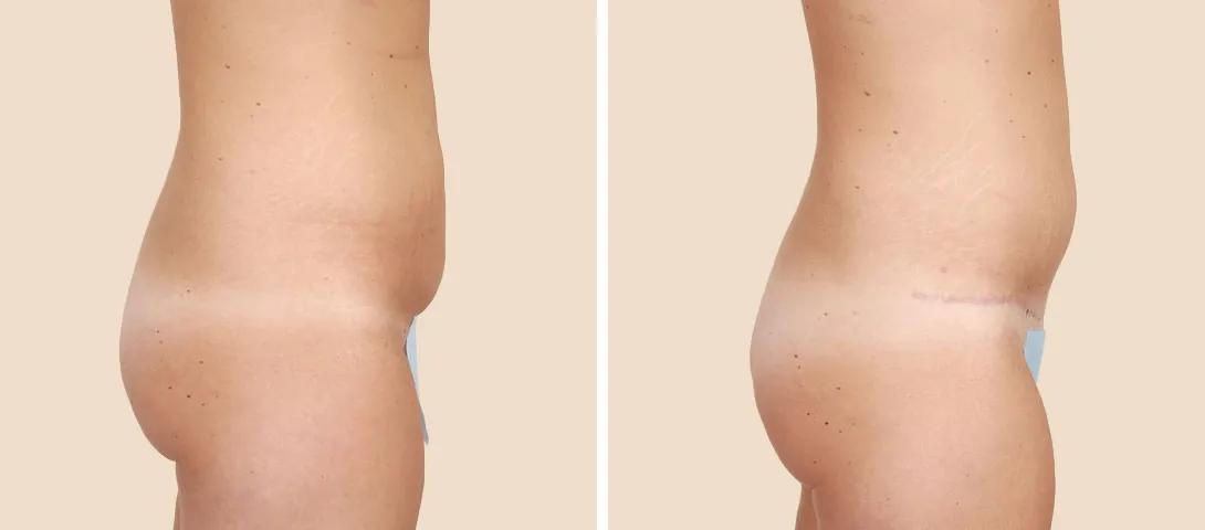 Side View - Before and After