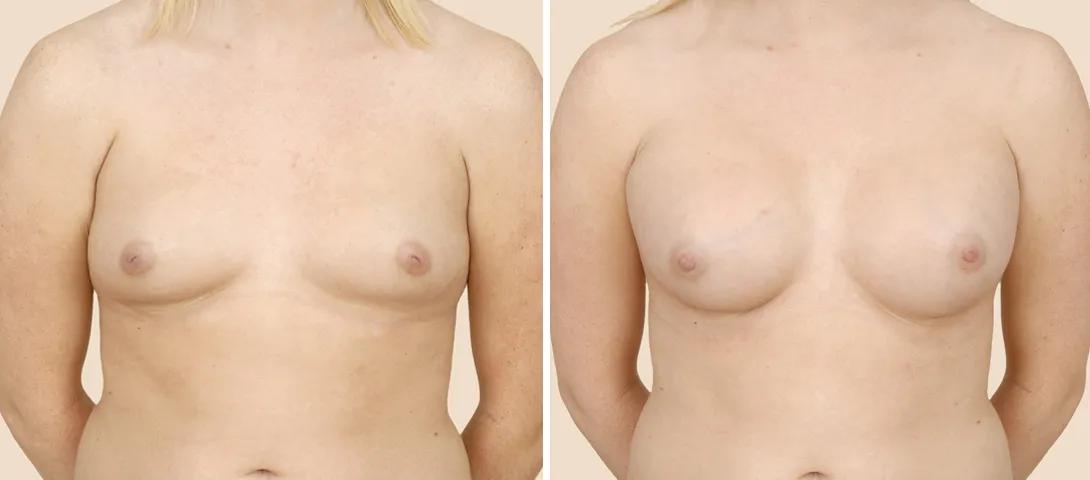 Breast augmentation before & after photo