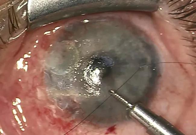 Figure 1: Intraoperative view prior to graft insertion. The glued patch is visible at 10:00. A second area of glue at 8:00 has already been removed. Peripheral neovascularization is consistent with Terrien’s marginal degeneration. A suture has been pre-placed and a Lewicky AC maintainer is in place.
