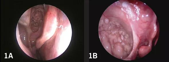 14-ENT-2019-Sindwani-Inset-Images-Figs-1a-1b-590pxl-width