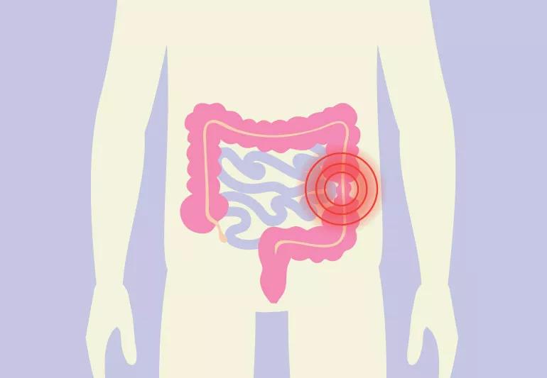 Can IBS Cause Back Pain?