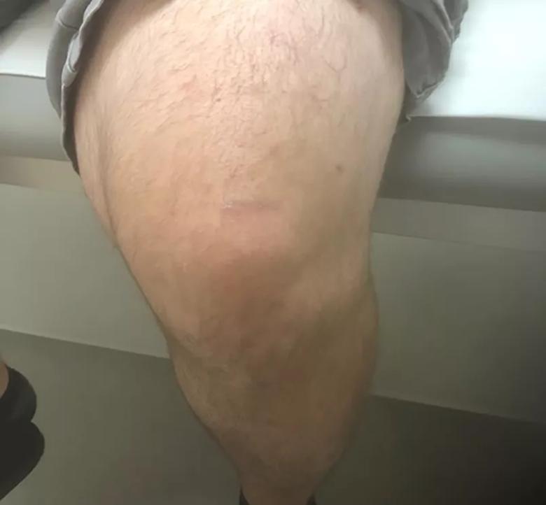 Post-surgery