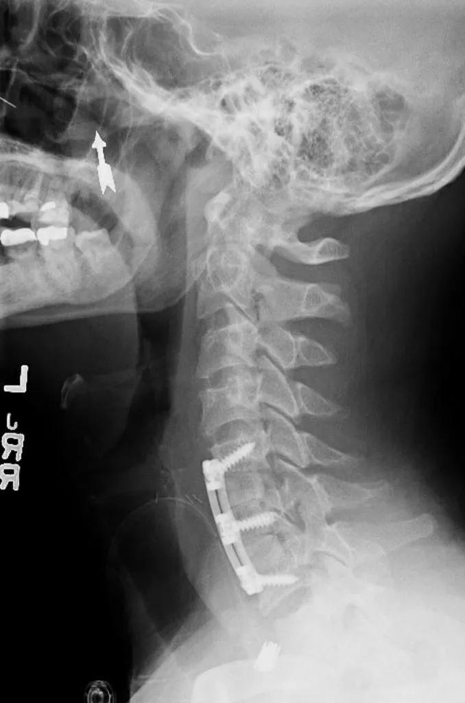 x-ray of a human neck showing hardware in the upper spine
