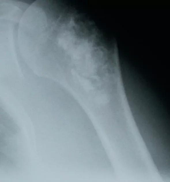 Figure 2. Anteroposterior radiograph showing an enchondroma of the proximal humerus. The calcification pattern largely resembles the “popcorn” appearance of the typical benign enchondromatous lesion.