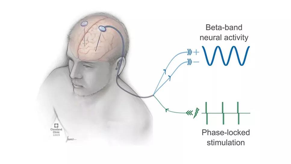 parkinson's center sarasota using glutathione and functional neurology Parkinson's in Sarasota main image 1