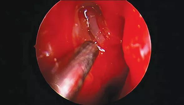 Figure. Endoscopic view (via 4-mm rigid endoscope) after osteotomy and lacrimal sac incision (right) in a 22-month-old patient undergoing endoscopic DCR. The middle turbinate is on the right.