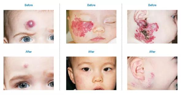 Figure. Photos from representative cases of infantile hemangioma managed under the SCAMP paradigm for propranolol treatment in Cleveland Clinic Children’s Vascular Anomalies Program. Left: Forehead hemangioma with deep and superficial components at presentation at 6 months of age (note brow distortion) and after seven months of treatment. Middle: Facial lesion at presentation at 1 month of age andafter 16 months of treatment. Right: Ulcerated hemangioma at presentation at 2 months of age (note distortion of the right cheek and jawline) and after 14 months of treatment.