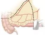 Extended mesenteric excision.