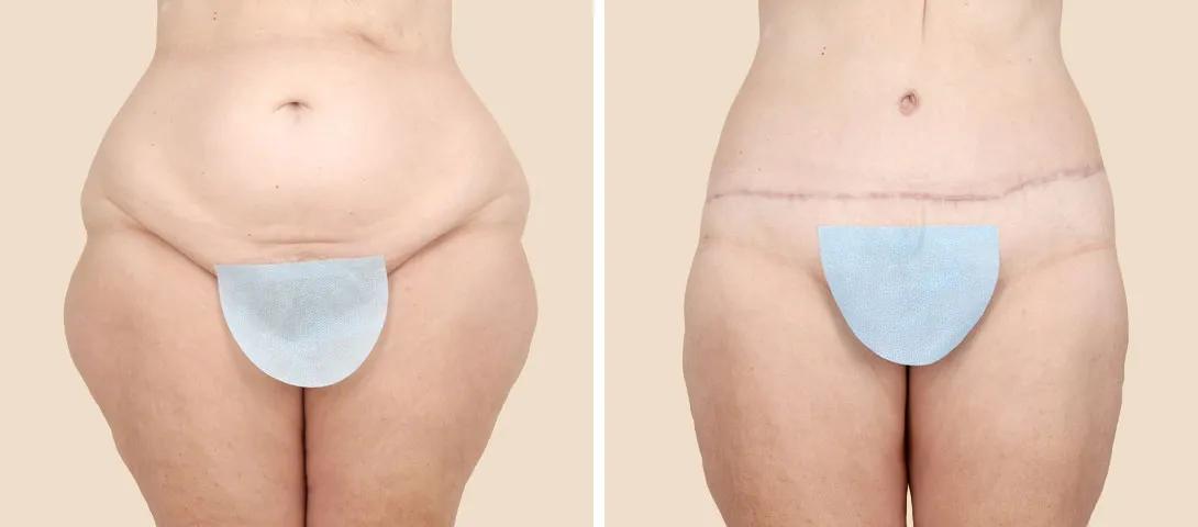 Front View - Before and After
