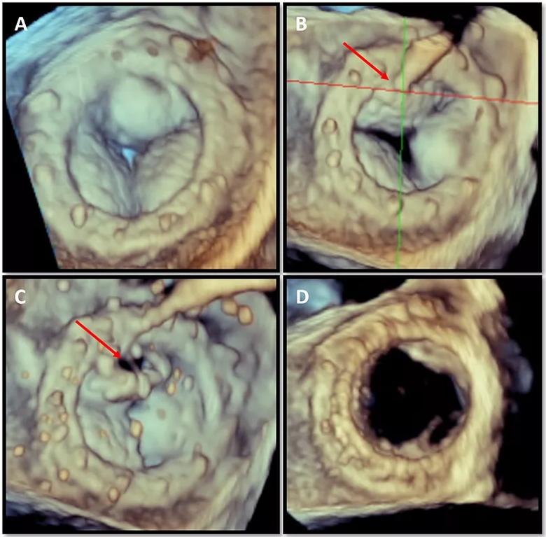3D transesophageal echocardiographic images from a CLEVE procedure