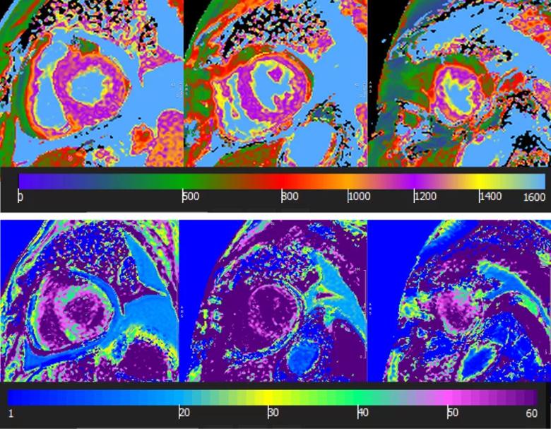 T1 mapping with extracellular volume quantification