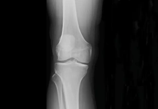 Radiographs showing lateral compartment joint space width.