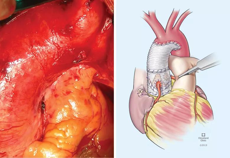 images of an aortic root aneurysm and aortic root reimplantation