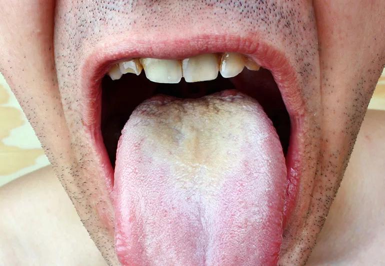 Thrush in shop throat treatment