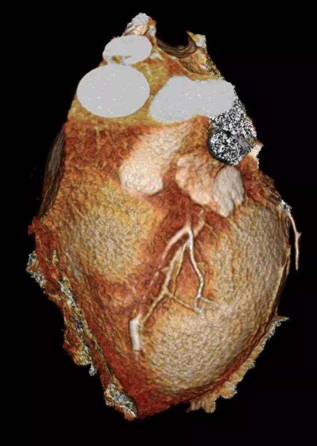 myocardial bridging