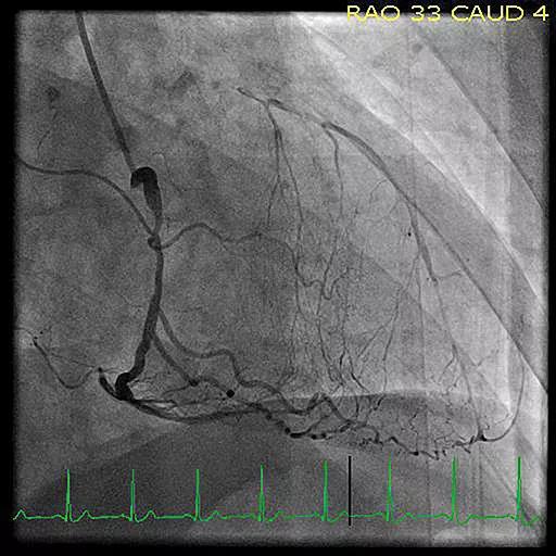 Figure. Catheterization image showing a totally occluded left anterior descending artery with right coronary artery stenosis, a combination that may prompt consideration of robotic hybrid revascularization.