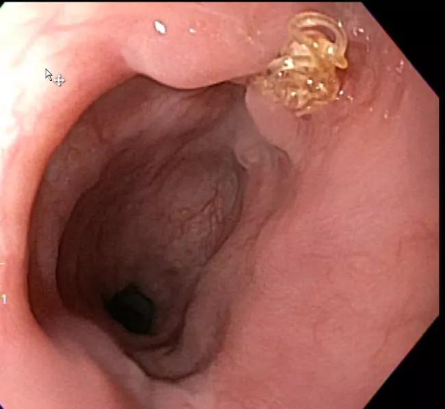 Figure 3. Endoscopy image taken three months postoperatively showing excellent healing with one suture visible.