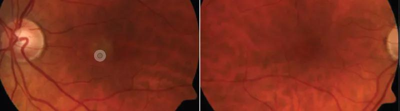 Fundus photo