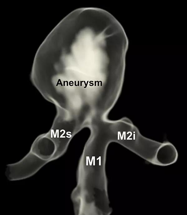 Three-dimensional angiogram of the right middle cerebral artery bifurcation.