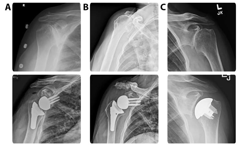 X-rays of 3 total shoulder replacements