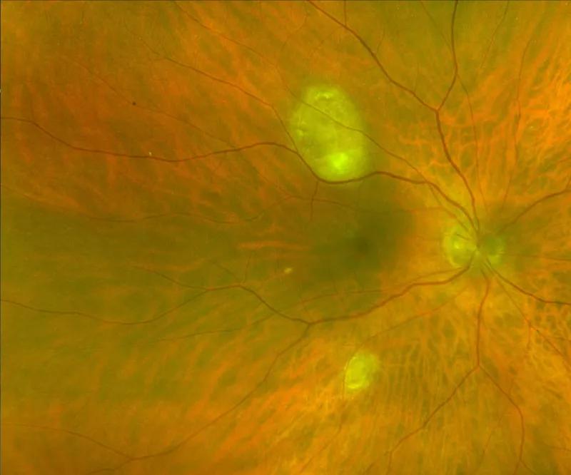 Eye