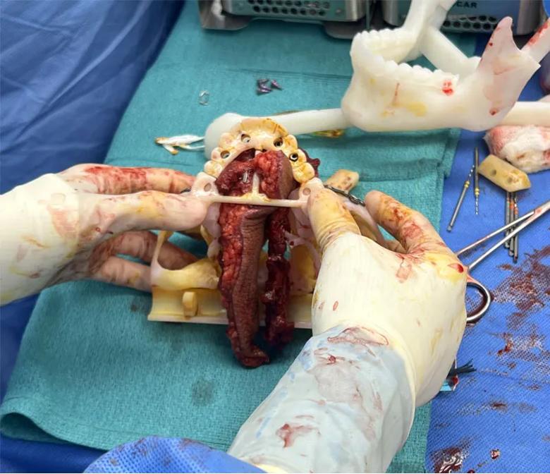The fibula flap with dental implants 