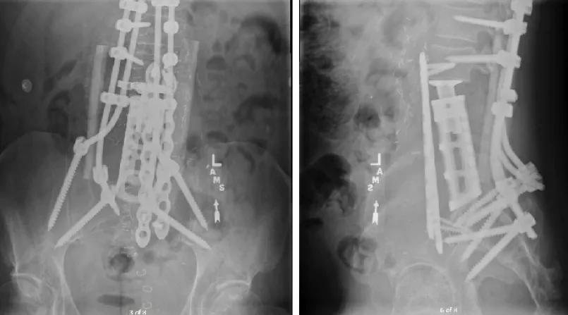 two imaging scans showing a spine with implanted screws and other instrumentation
