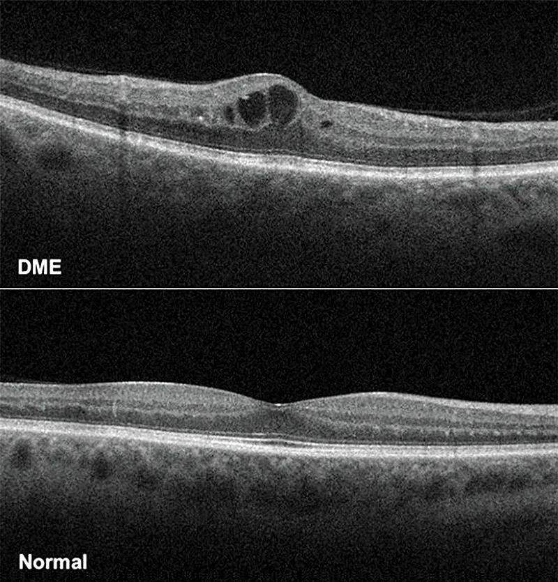 Diabetic macular edema compared to a healthy retina