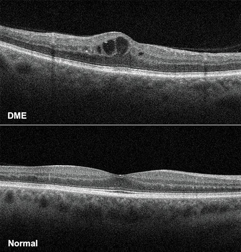 Diabetic macular edema compared to a healthy retina