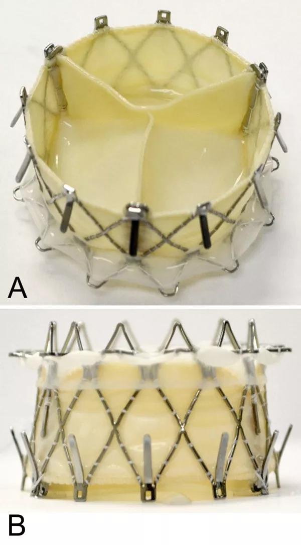Photos of the GATE valved stent showing the outflow (left ventricle) view and side view.
