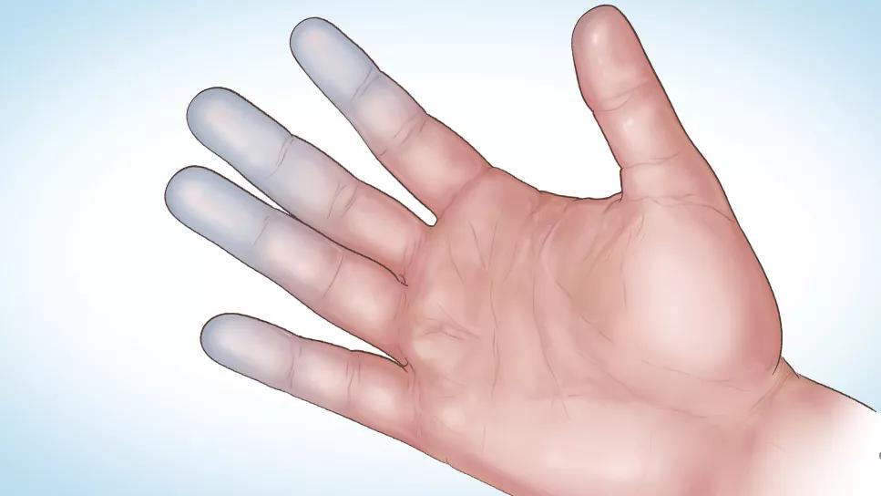 vibration white finger diagnosis What is Vibration White Finger Syndrome and How To Spot It