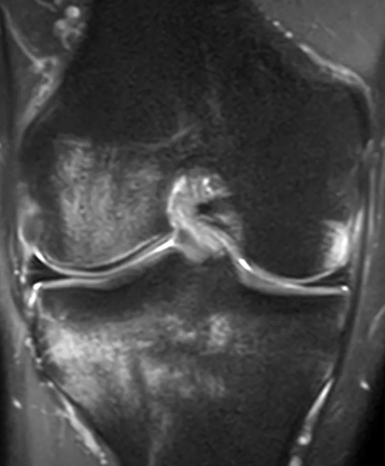 Coronal MRI showing bruising to medial femoral condyle three weeks after ACL rupture.