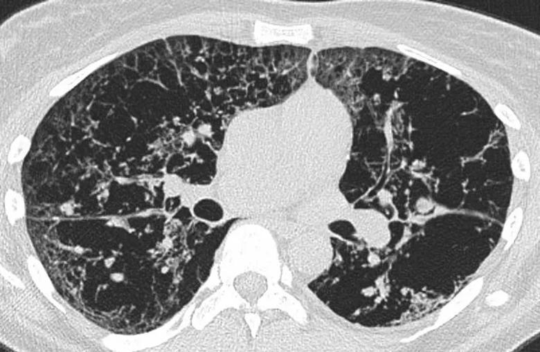 Biopsy scan with extensive cystic abnormalities