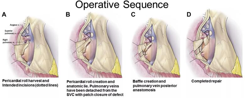 Surgical operative sequence