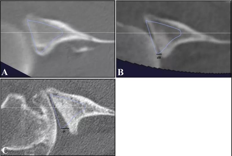 Shoulder arthritis