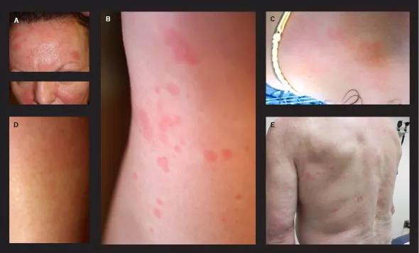 Dermatitis_Yao_590pxl-width