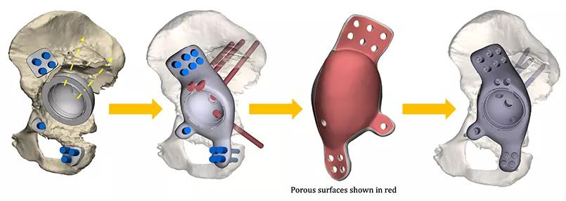 Design process, from concept to implant